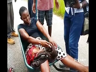 CALM LADY WITH HORRIBLE WOUND ON THE THIGH