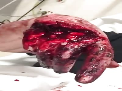 NAH... ITS JUST A SCRATCH IN THE HAND