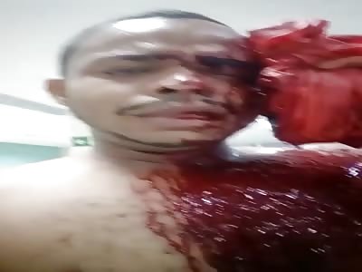 HE DIED OF HEMORRAGE