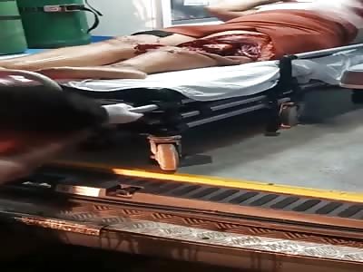 OUCH: YOUNG WOMAN WITH BROKEN FEMUR