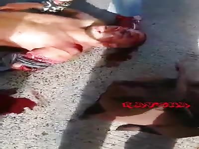 MAN WITH ARM SHATTERED IN AN ACCIDENT 