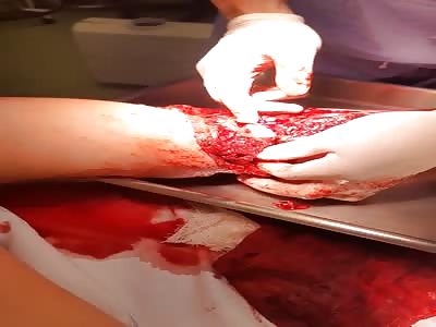 SURGICAL PROCEDURE FOR ARM AMUTATION