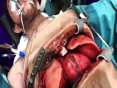 OPEN CHEST SURGERY