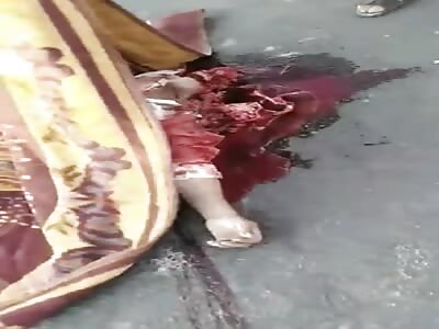 CRUSHED HEAD IN AN ACCIDENT 