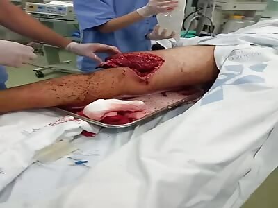 VICTIM OF WORK ACCIDENT