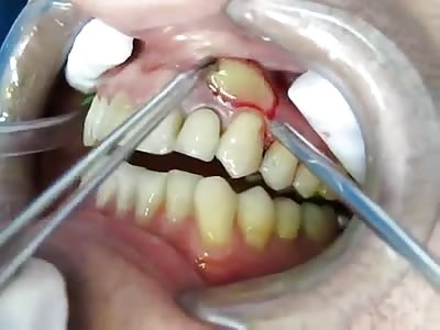 tooth abscess