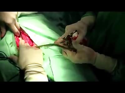 ectopic pregnancy  2