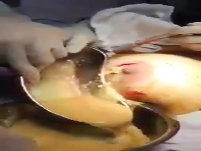 Necrosis of the breast, the side effects of breast implants. It is best when it natural