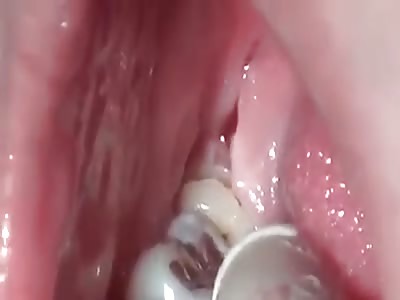 MUELA OF TRIAL JUDGMENT (EXTRACTION)