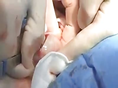 A small plaque in the bladder