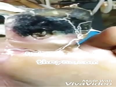 Diabetic finger with gangrene and worms