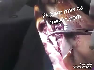 Diabetic foot surgery