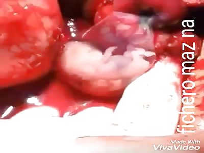 12-week ectopic pregnancy