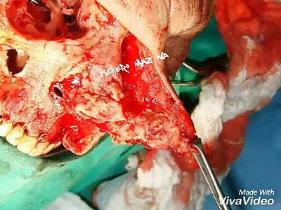 Old woman operated on face