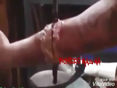 Man with hand caught in machine