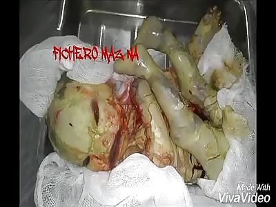 (Shocking) very sad born with reptile skin