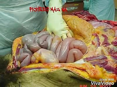 Autopsy to man who had drug in the guts