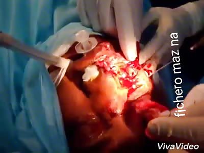 Excellent facial reconstruction after accident