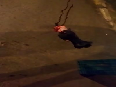 Girl loses her leg in the accident