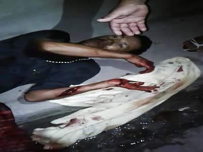 He's Alive!! Man Hacked Apart with Dangling Severed Arm  