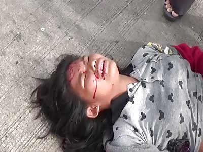 Asian Women with Horribly Fractured Leg Rolling in the Road