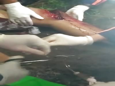 MAN WITH WOUNDED LEG