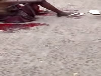 WOMAN WITH DEPRESSED FOOT