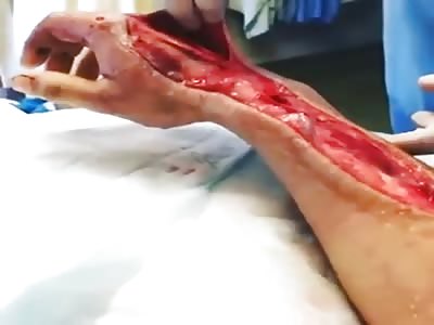 HAND WITH SERIOUS WOUND