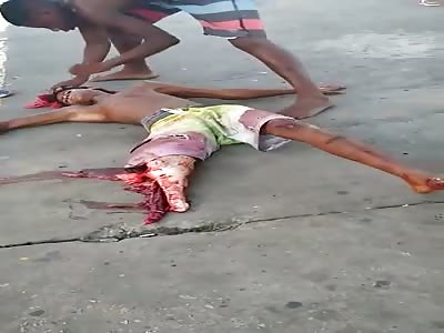 Poor Boy with Nasty Leg Break has his Foot