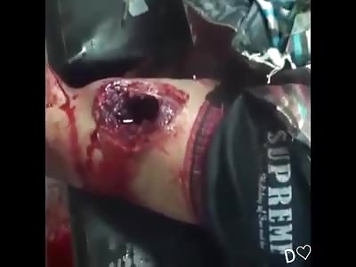 MAN WITH WOUND IN THE ARM