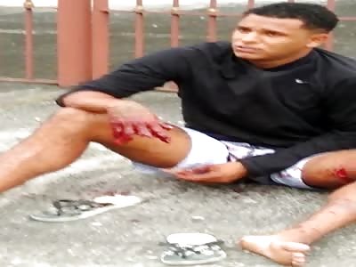 Thief Fingers Amputated by Bullet