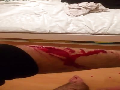 ARM WITH WOUND PENKNIFE