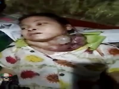 Rare disease of the girl in the neck