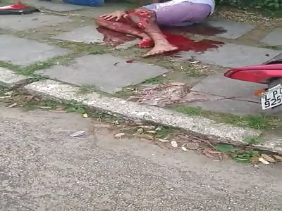 Shattered leg after accident