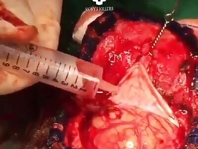 Drainage of brain abscess