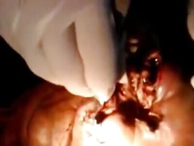 many maggots removed from cracked face 