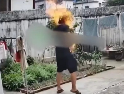 Electronic Cigarette Explosion on Mans Face