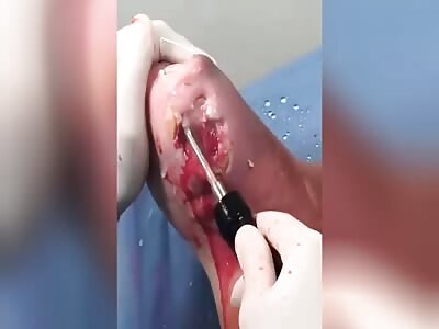 Diabetic foot treatment.