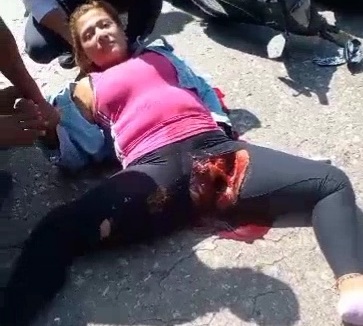 Colombian Woman Lost her Vagina in Horrific Motorcycle Crash 