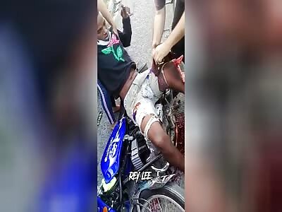 Tourniquets for a shabby leg 