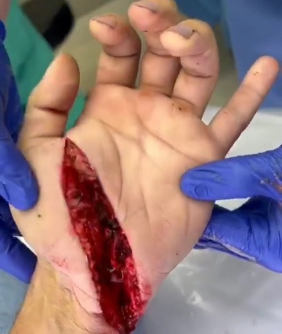 Horrific machete wound in the gand 