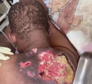 Rotten back of diabetic person 