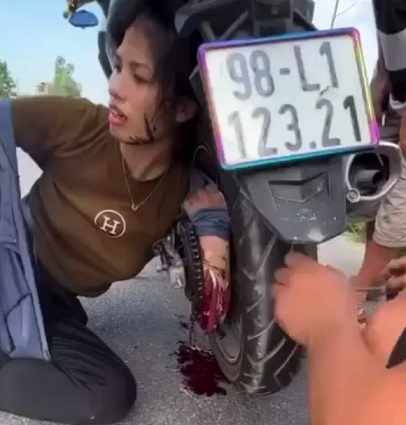 It's Very Likely The Woman Will Be Left Without An Arm