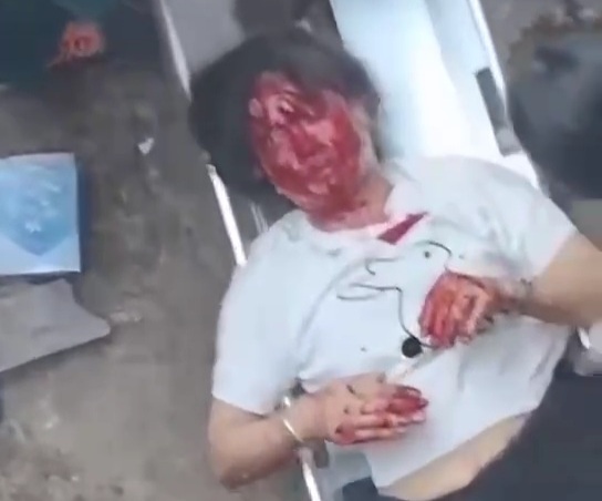 [ACCIDENT+AFTERMATH]Woman on moped lost control horribly fall into pit