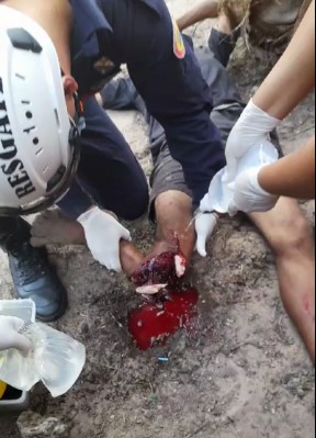 Damn, the man fell off the coconut tree