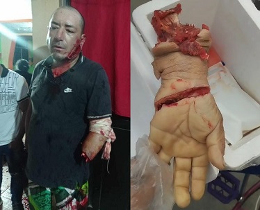 Man Lost Hand In Machete Fight (Action & Aftermath)