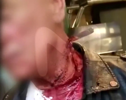 man with a knife in his neck came to a bar and demanded to be treated.