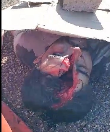 Brazilian man has his skull emptied in accident