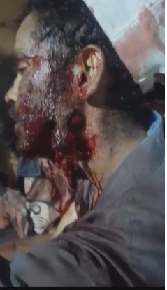 victim was stabbed in the face