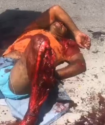 Victim with serious leg injury